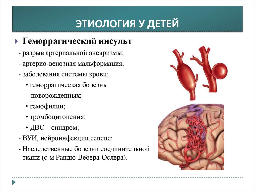 Инсульт последствия. Причины ишемического инсульта у детей. Геморрагический инсульт у детей. Причины геморрагического инсульта у детей. Этиологические факторы ишемического инсульта у детей.