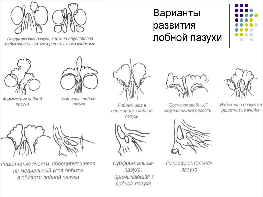 Варианты формирования. Варианты развития лобных пазух. Варианты строения лобной пазухи. Рентгенодиагностика синуситов. Аномалия развития лобной пазухи.