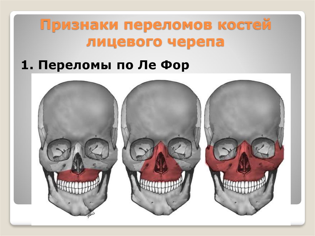Перелом лицевого черепа. Перелом лицевого черепа по типу Лефор. Травмы костей лицевого черепа. Перелом костей лицевого черепа.