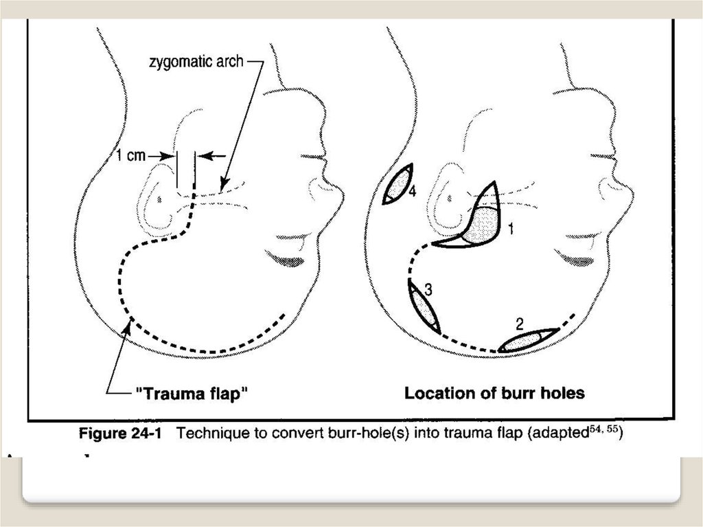 Trauma Multiple finger degloving treated with medial cross arm flap and  temporary syndactyly