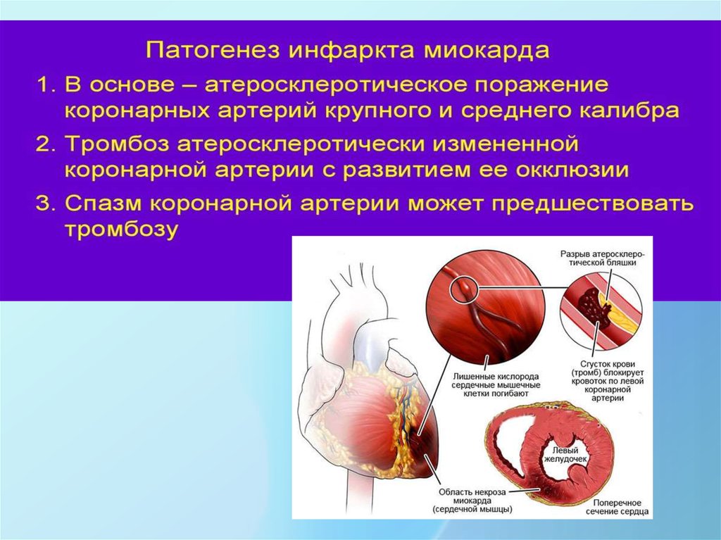 Инфаркт миокарда причины. Механизм развития инфаркта. Презентация на тему инфаркт миокарда. Механизм инфаркта миокарда. Изменения коронарных артерий при инфаркте миокарда.