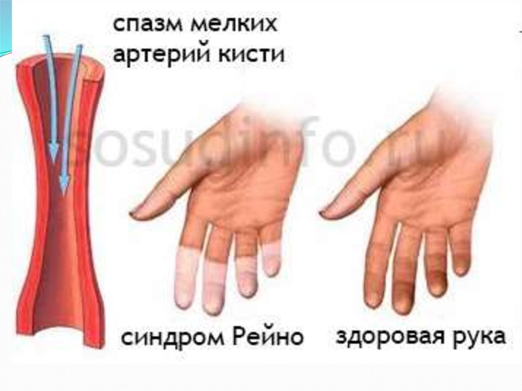 Синдром рейно это простыми словами