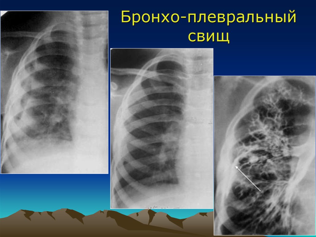 Врожденный туберкулез. Бронхиальный свищ рентген. Пневмония и эмпиема плевры. Туберкулезная эмпиема рентген. Бронхоплевральный свищ.