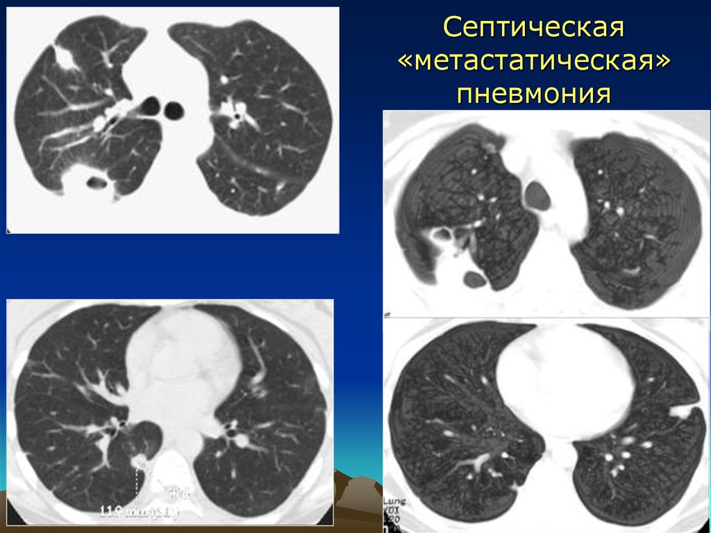 Бронхопневмония кт картина