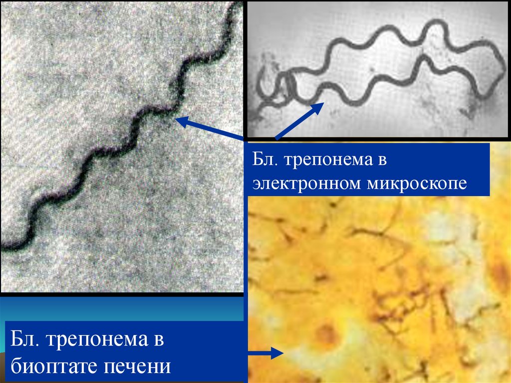 Treponema pallidum в рмп. Трепонема микроскопия. Трепонема паллидум под микроскопом. Трепонема электронная микроскопия.