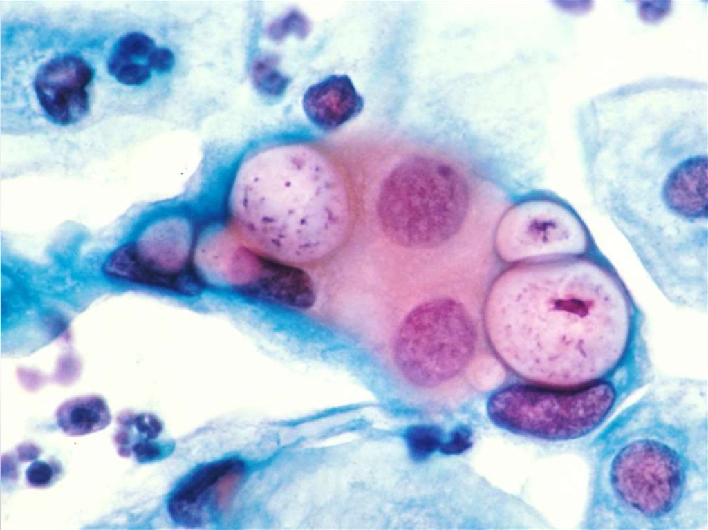День хламидии. Урогенетический хламидиоз. Chlamydia trachomatis под микроскопом. Хламидия трихоматис под микроскопом.