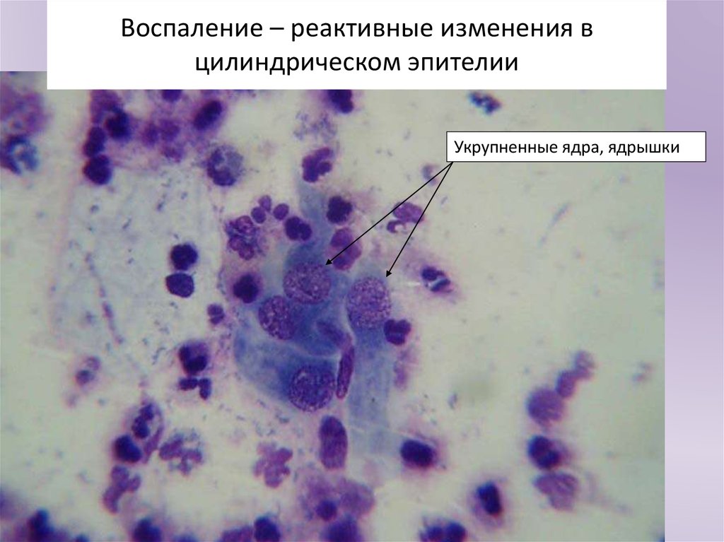 Воспаление с реактивными изменениями клеток. Клетки цилиндрического эпителия в мазке что это такое. Бактериальный вагиноз микроскопия мазка. Цилиндрический эпителий шейки. Цилиндрический эпителий шейки матки цитология.