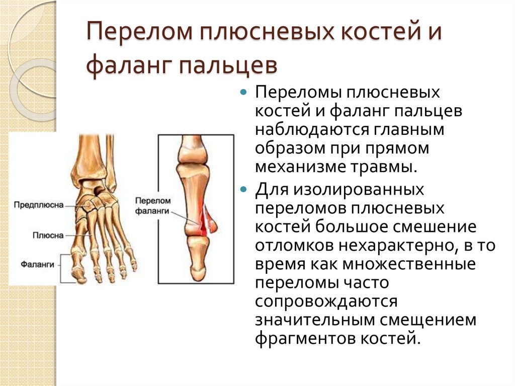 Фаланги пальца тип соединения. Перелом кости предплюсны стопы. Метаэпифиз плюсневой кости. Предплюсна плюсна фаланги пальцев. Перелом плюснои5 кости.