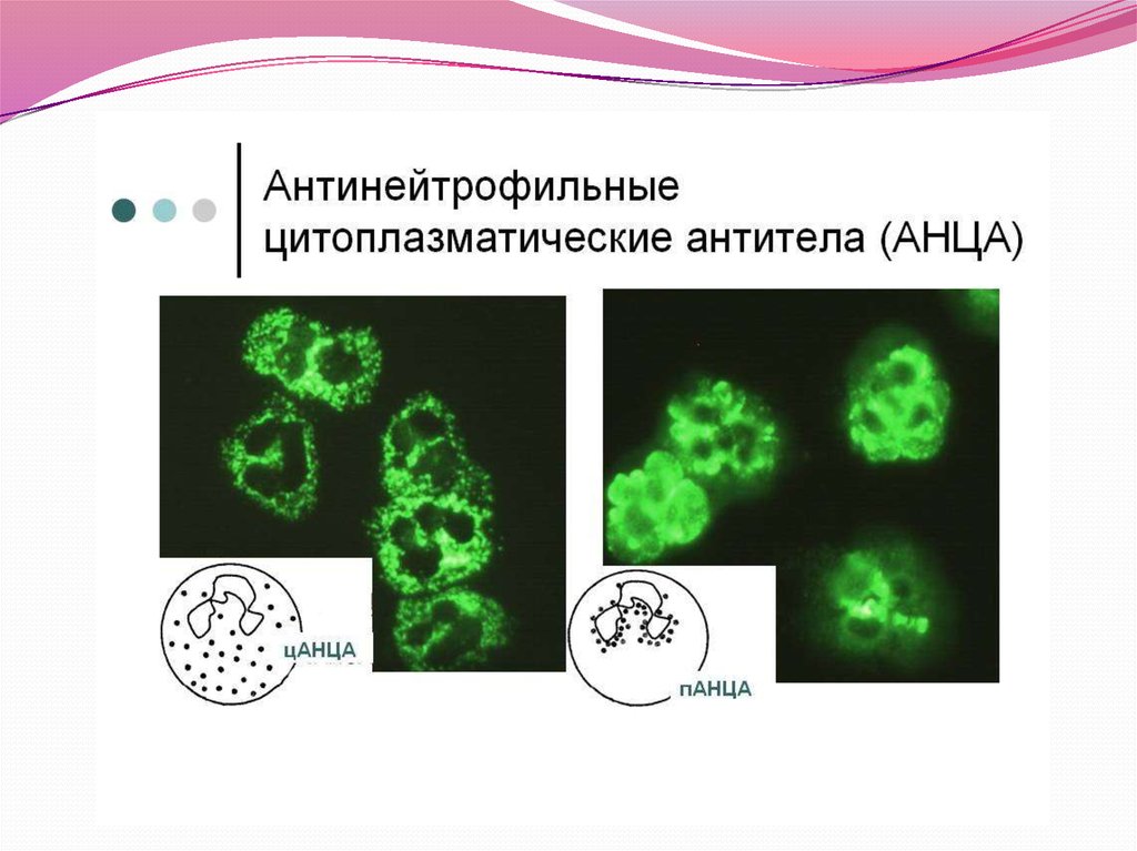 Болезнь антитела. Антитела к цитоплазме нейтрофилов АНЦА норма. АНЦА К протеиназе 3. АНЦА АТ. Перинуклеарные Антинейтрофильные цитоплазматические антитела.