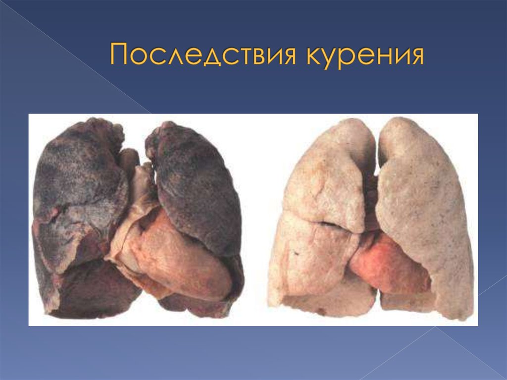 Последствия курения