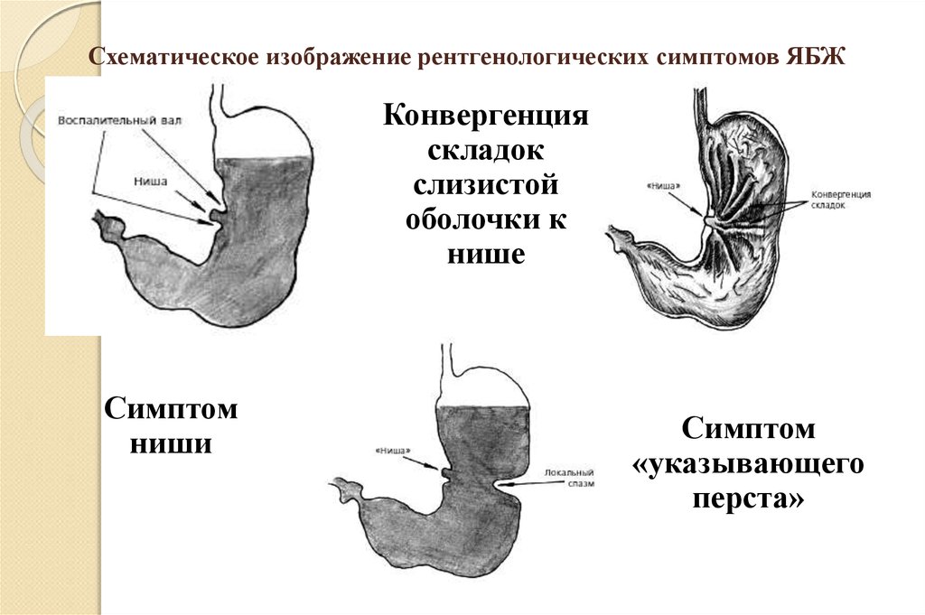 Первый симптом рака желудка. Конвергенция складок при язве желудка рентген. Конвергенция складок слизистой желудка это. Конвергенция складок слизистой желудка рентген.