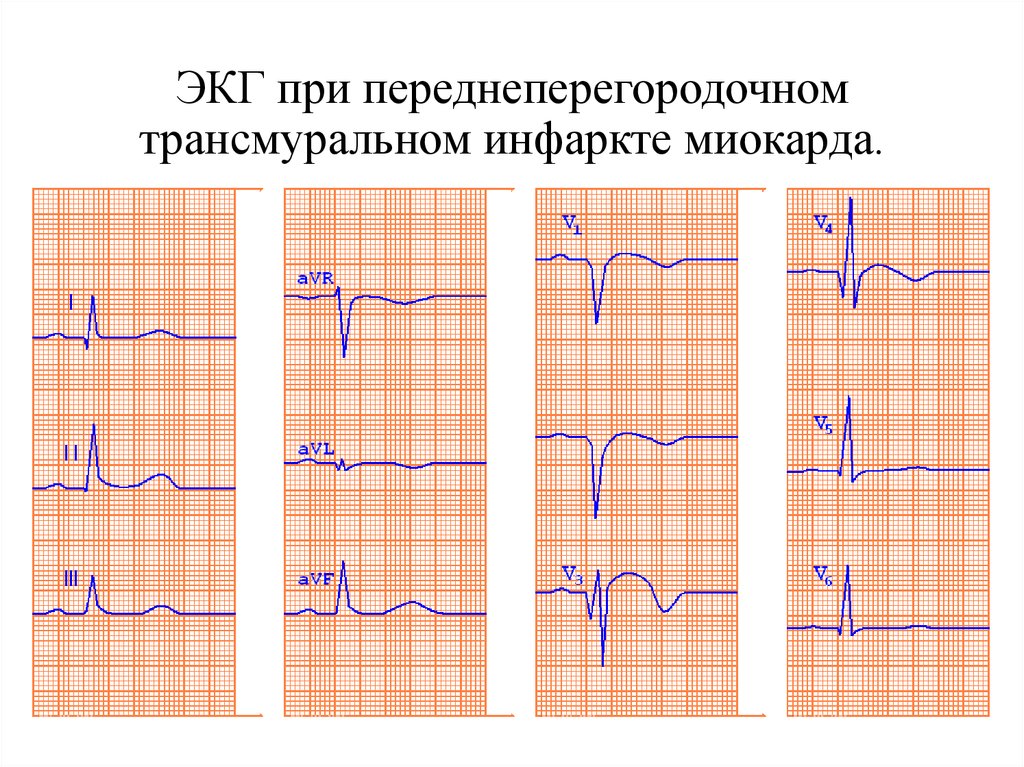 Признаки трансмурального инфаркта