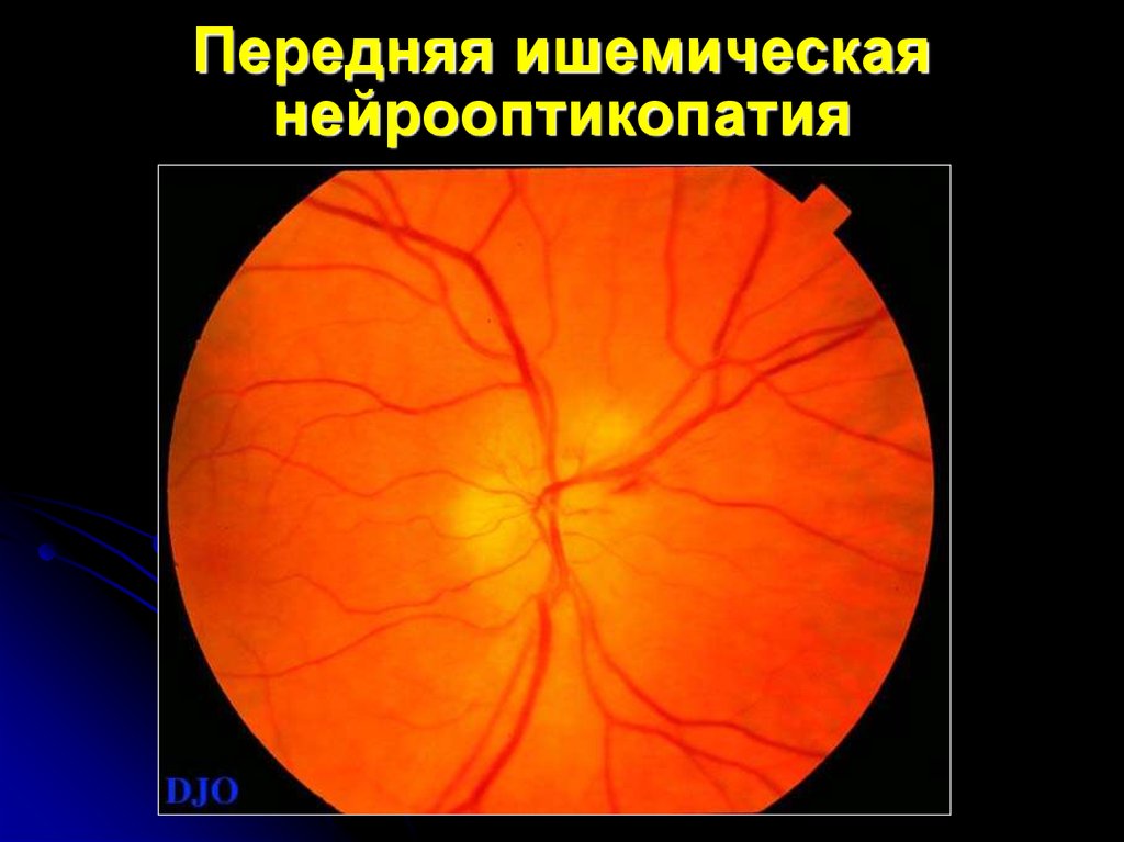 Нейропатия зрительных. Ишемическая нейропатия глазное дно. Ишемическая невропатия зрительного нерва. Задняя ишемическая нейропатия зрительного нерва. Передняя ишемическая нейропатия зрительного нерва.