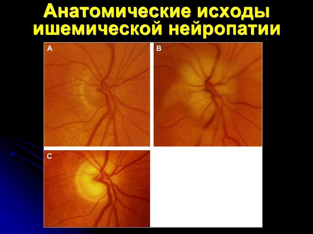 Передняя ишемическая нейропатия. Ишемическая нейропатия зрительного нерва. Задняя ишемическая нейропатия зрительного нерва. Нейрооптикопатия зрительного нерва. Ишемическая нейропатия глаза.