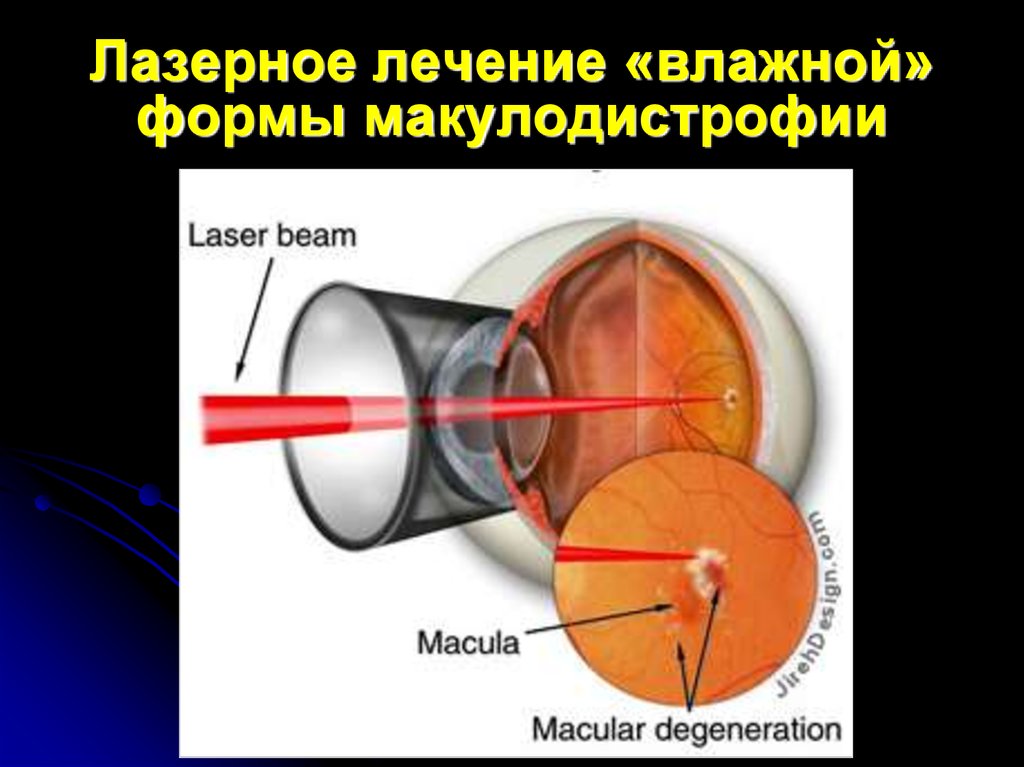 После укрепления сетчатки. Фокальная лазеркоагуляция сетчатки глаза. Фокальная лазерная коагуляция сетчатки глаза. Ограничительная лазеркоагуляция сетчатки глаза. Макулодистрофия, макулярная дегенерация.