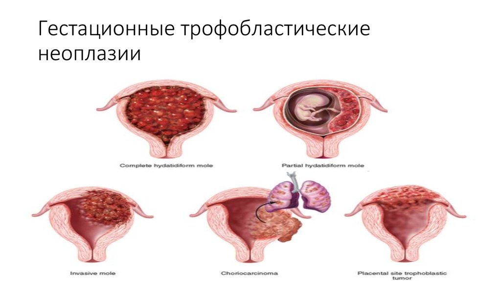 Неоплазия что это у женщин. Трофобластические опухоли плацентарного ложа. Гестационная трофобластическая неоплазии. Трофобластическая опухоль. Гестационная трофобластическая болезнь.