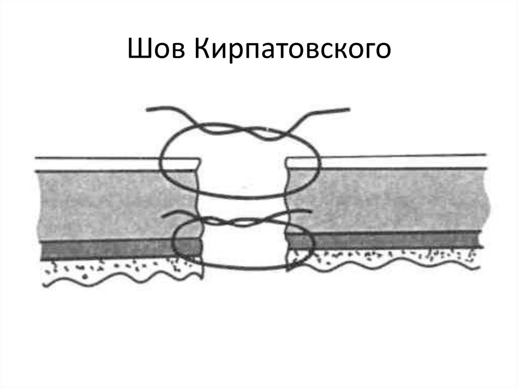 Шов Кирпатовского