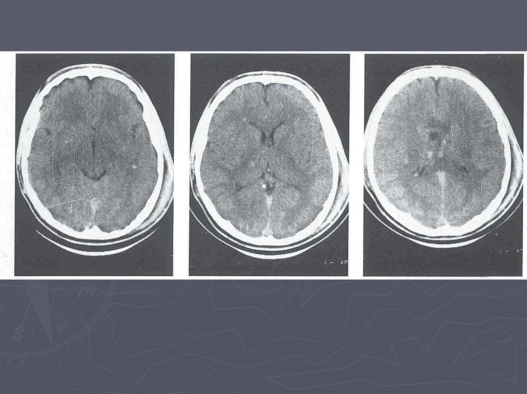 Отечность головы. Сотрясение головного мозга на кт. Диагностические критерии отека головного мозга. Кт картина отека головного мозга.