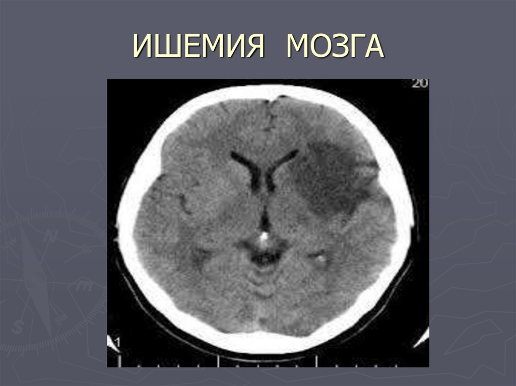 Диагноз ишемия мозга. Ишемический инсульт на кт головного мозга. Ишемический инсульт снимок кт. Кт мозга при хронической ишемии головного мозга. Ишемический инсульт мрт.