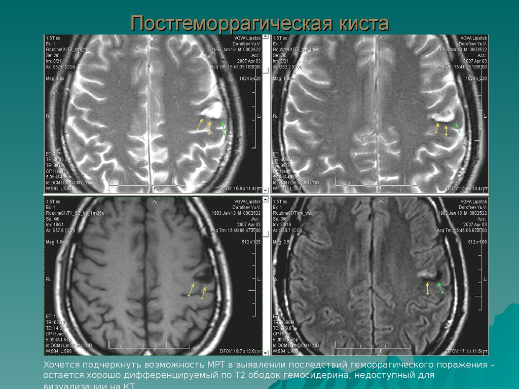 Ишемия мозга мрт. Мрт головного мозга при ишемическом инсульте. Ишемический инсульт мрт снимок. Постгеморрагическая киста головного мозга мрт. Мрт головного мозга геморрагический инсульт.