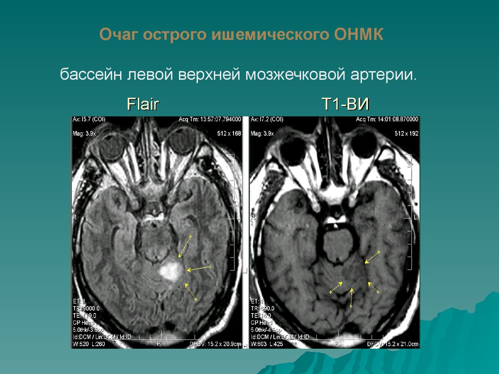 Ишемический инсульт в бассейне правой. Аневризма мозжечковой артерии. Мозжечковый инсульт кт. Задняя мозжечковая артерия на кт. Мозжечковый инсульт мрт.