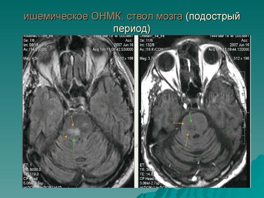 Ишемический инсульт головного мозга на мрт фото