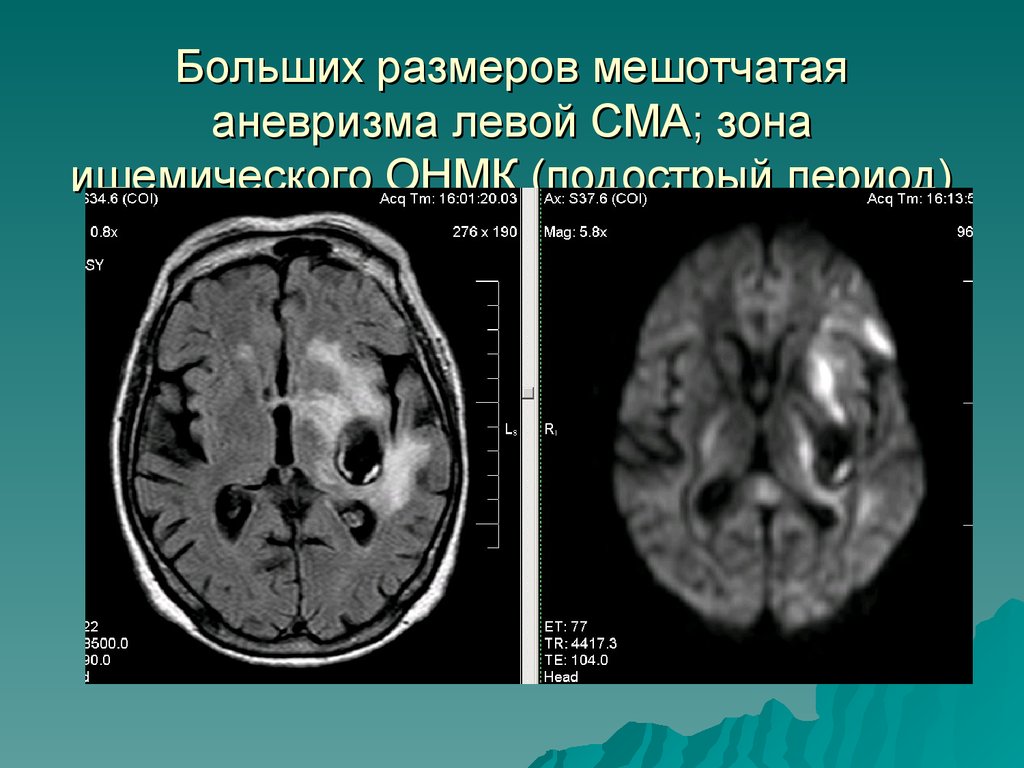 Сма мозга. Аневризмы левой СМА ( сегмент м1). Мешотчатая аневризма средней мозговой артерии. Мешотчатая аневризма левой СМА. Аневризма головного мозга СМА.