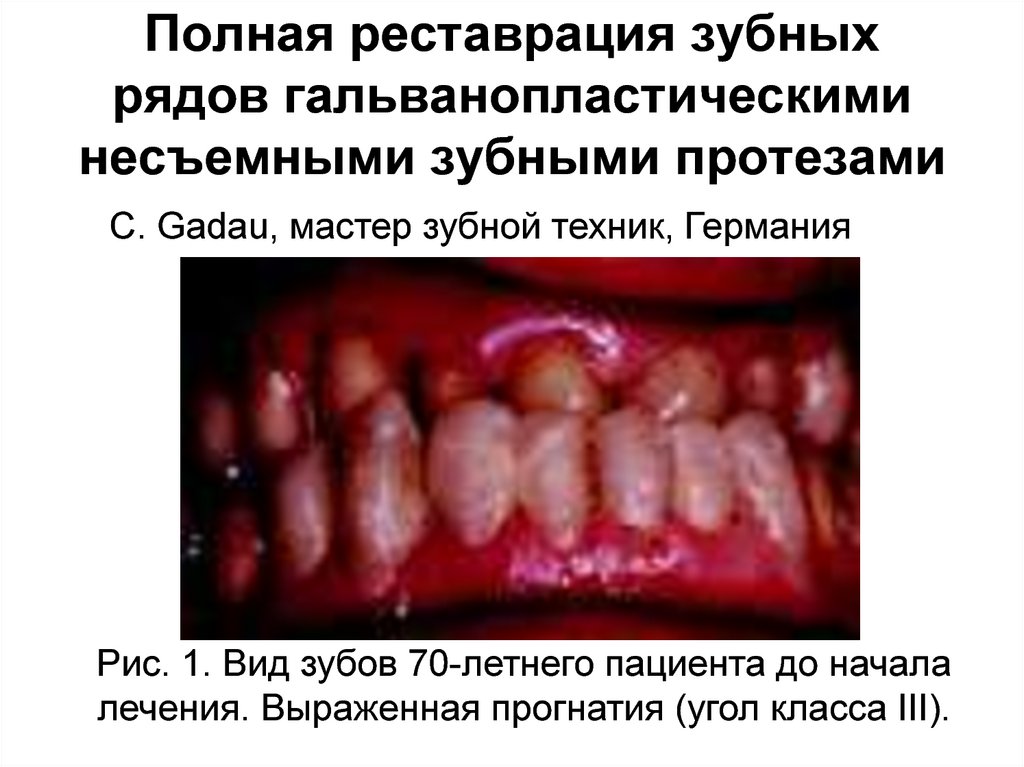 Полная реставрация зубных рядов гальванопластическими несъемными зубными протезами