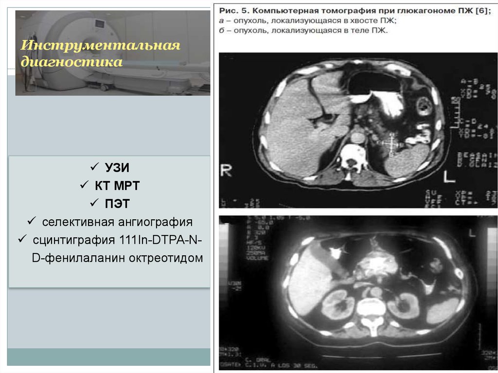Опухоль головки поджелудочной железы прогноз. Глюкагонома поджелудочной железы кт. Випома поджелудочной железы кт. Инсулинома и глюкагонома. Нейроэндокринная опухоль поджелудочной железы кт.