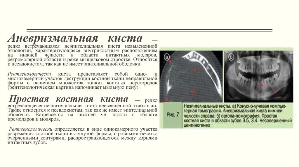 Доброкачественные опухоли челюстно лицевой области классификация презентация