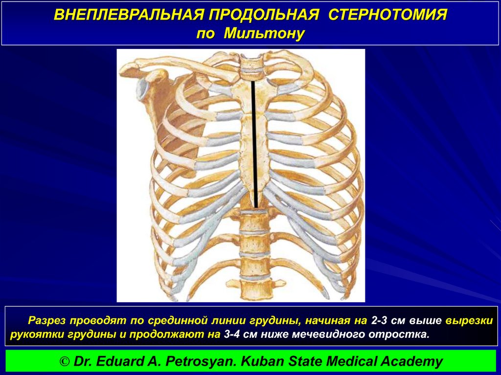 ВНЕПЛЕВРАЛЬНАЯ ПРОДОЛЬНАЯ СТЕРНОТОМИЯ по Мильтону