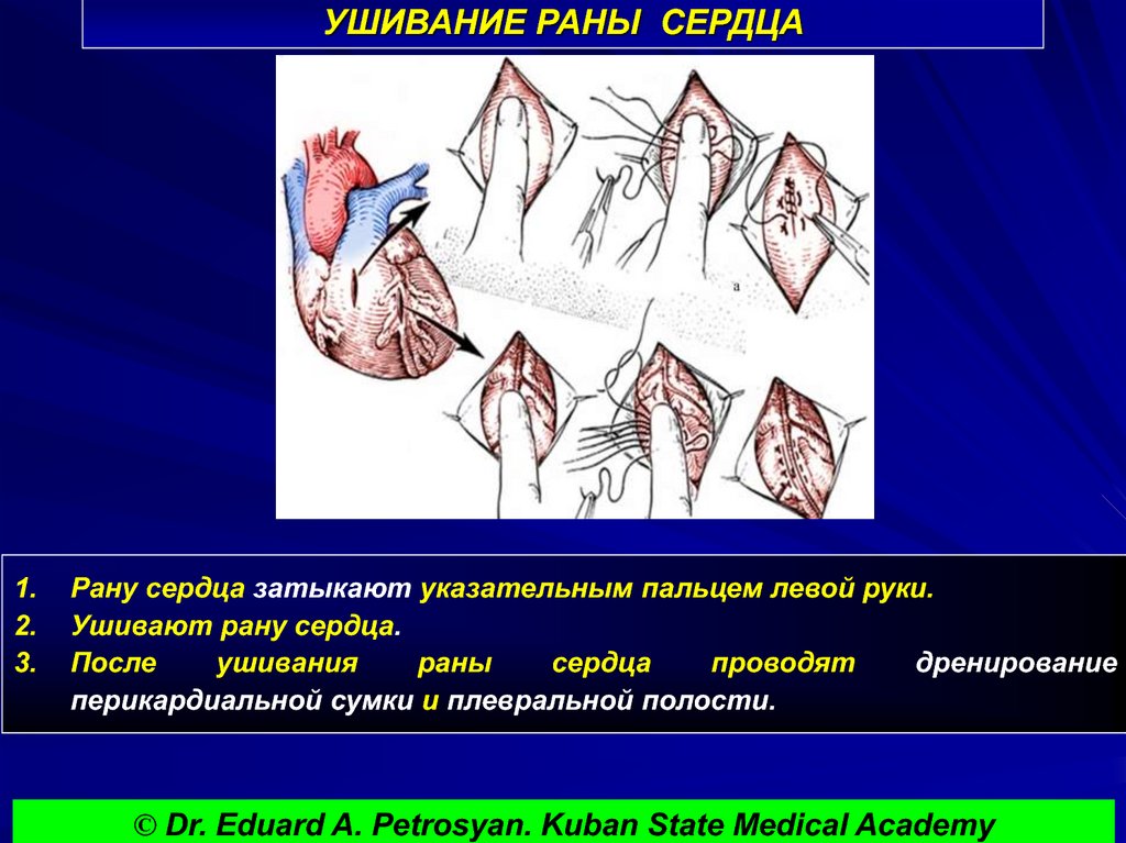 УШИВАНИЕ РАНЫ СЕРДЦА