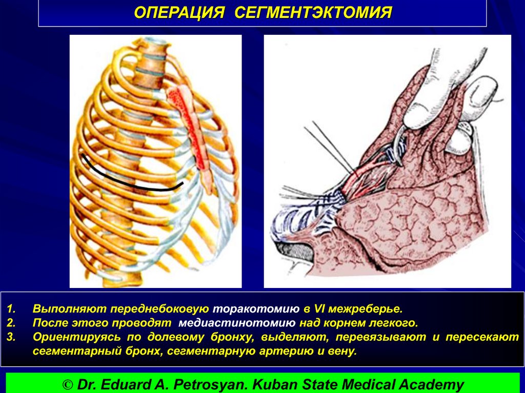 Удаление легкого. Сегментэктомия легкого. Сегментарная резекция легкого. Сегментэктомия легкого показания. Удаление сегмента легкого операция.