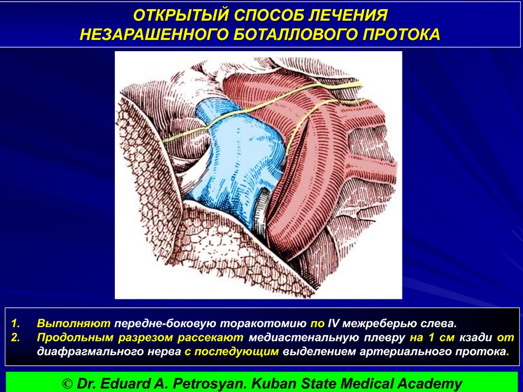протока операция