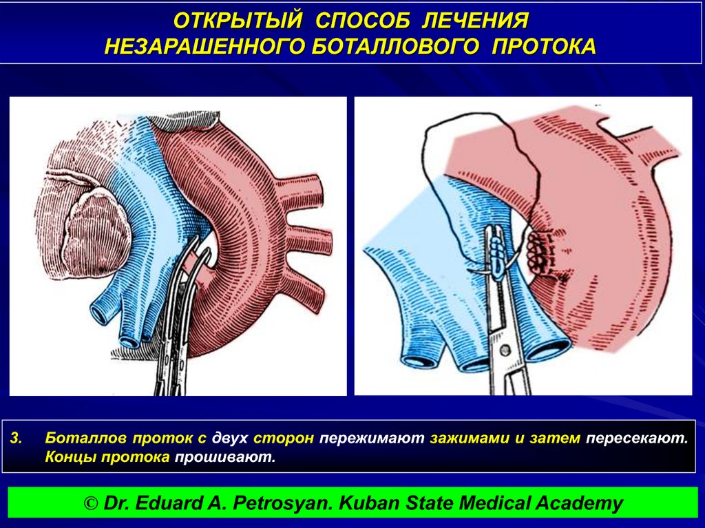 Открытый метод. Операции при открытом артериальном протоке топографическая анатомия. Открытый артериальный (боталлов) проток операция. Перевязка артериального боталлова протока. Открытый артериальный проток перевязка операция.