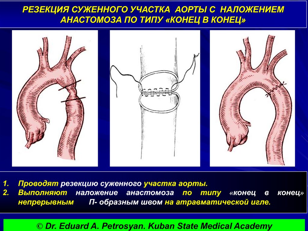 Аневризма аорты карта вызова