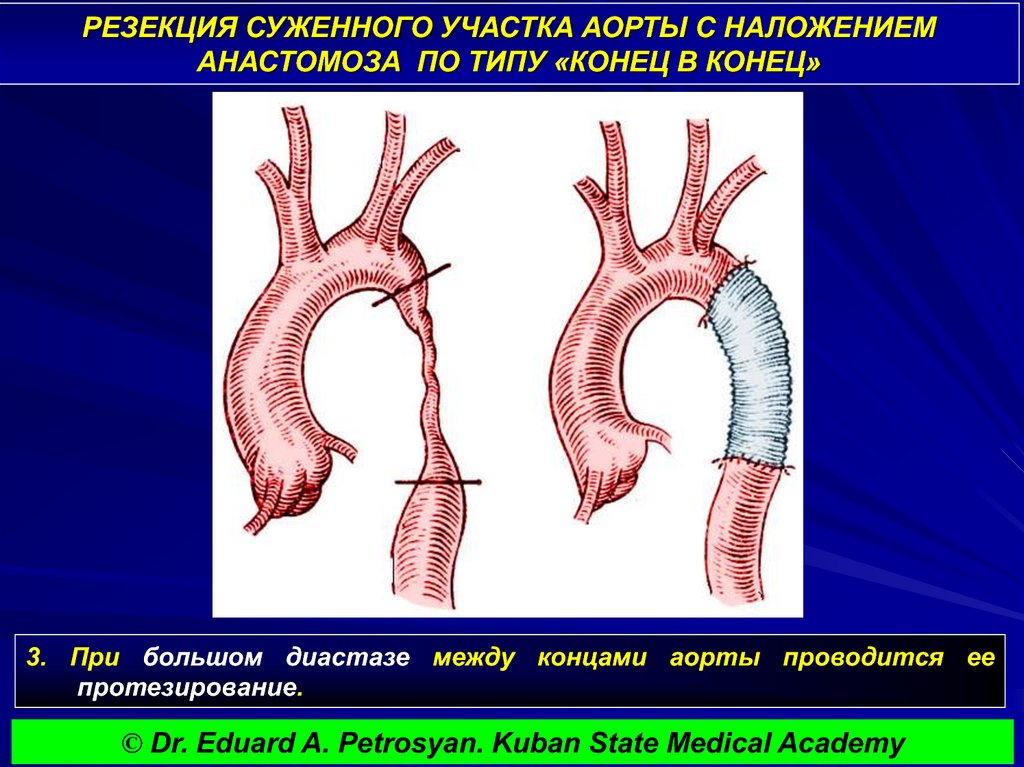 Аорта клинические рекомендации