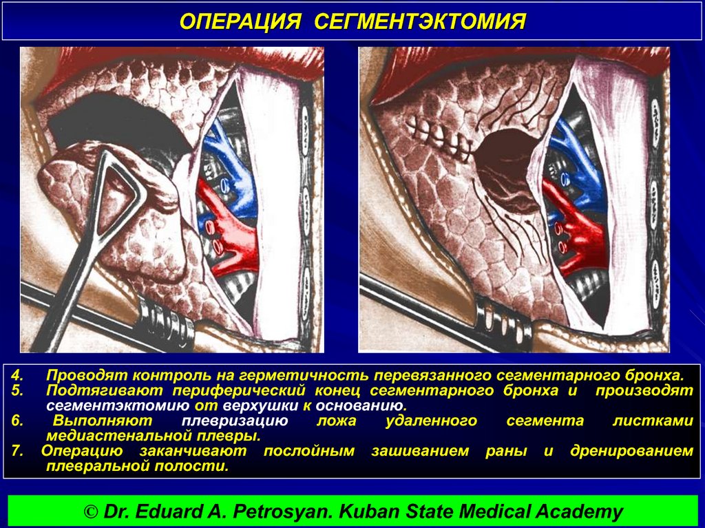 ОПЕРАЦИЯ СЕГМЕНТЭКТОМИЯ