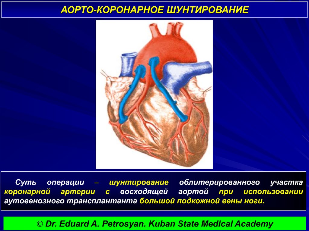 Что такое шунтирование сердца и сосудов. Маммарокоронарное шунтирование сердца. Коронарное шунтирование сосудов сердца. Схема операции аортокоронарного шунтирования. Артерио коронарное шунтирование.