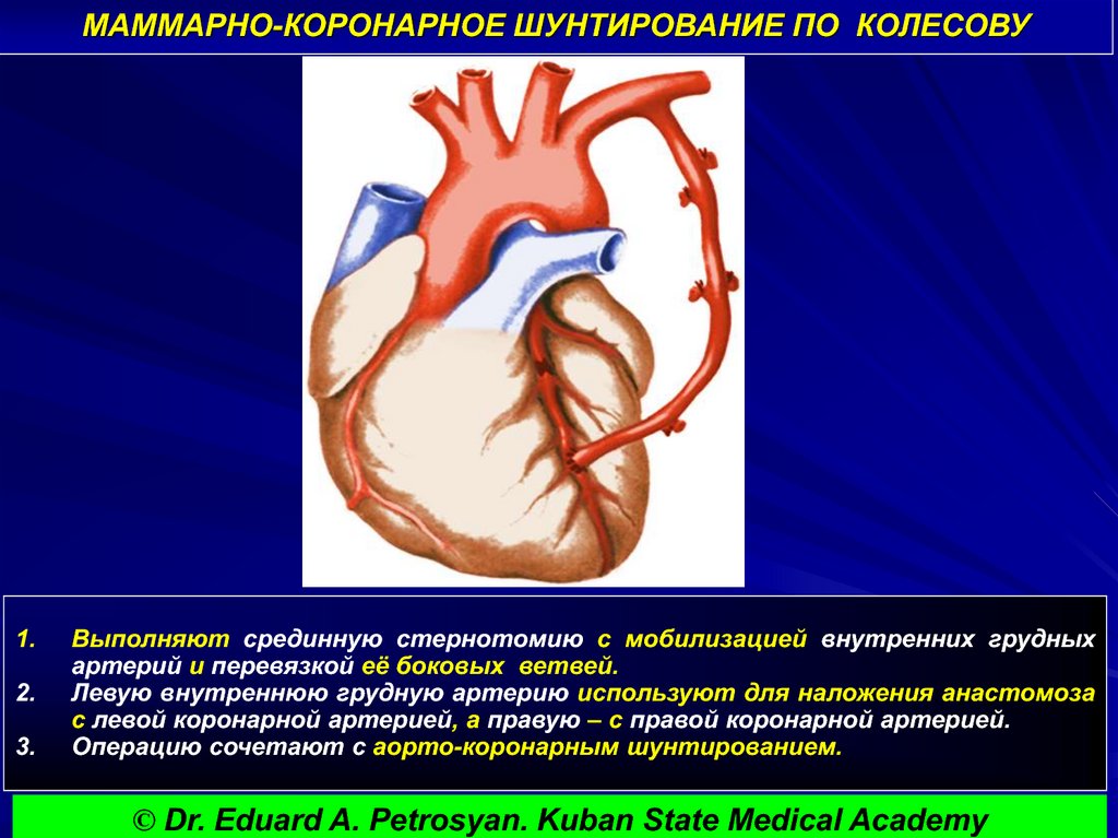 Что такое шунтирование сердца и сосудов. Операция Колесова маммарно коронарное шунтирование. Аортокоронарное шунтирование техника. Маммарокоронарное шунтирование техника. Аортокоронарное шунтирование ЭФЛЕР.