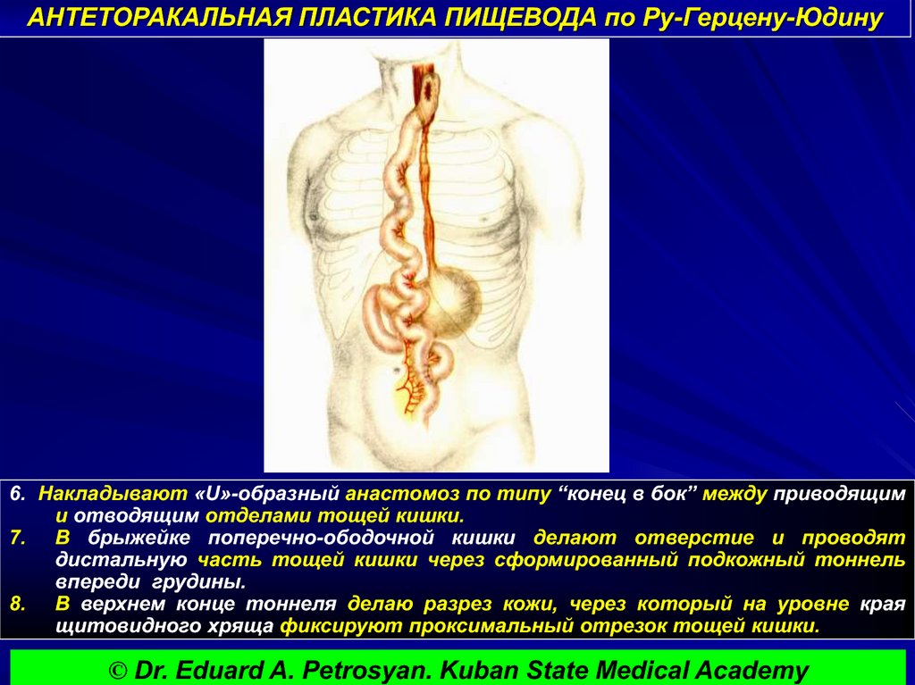 АНТЕТОРАКАЛЬНАЯ ПЛАСТИКА ПИЩЕВОДА по Ру-Герцену-Юдину