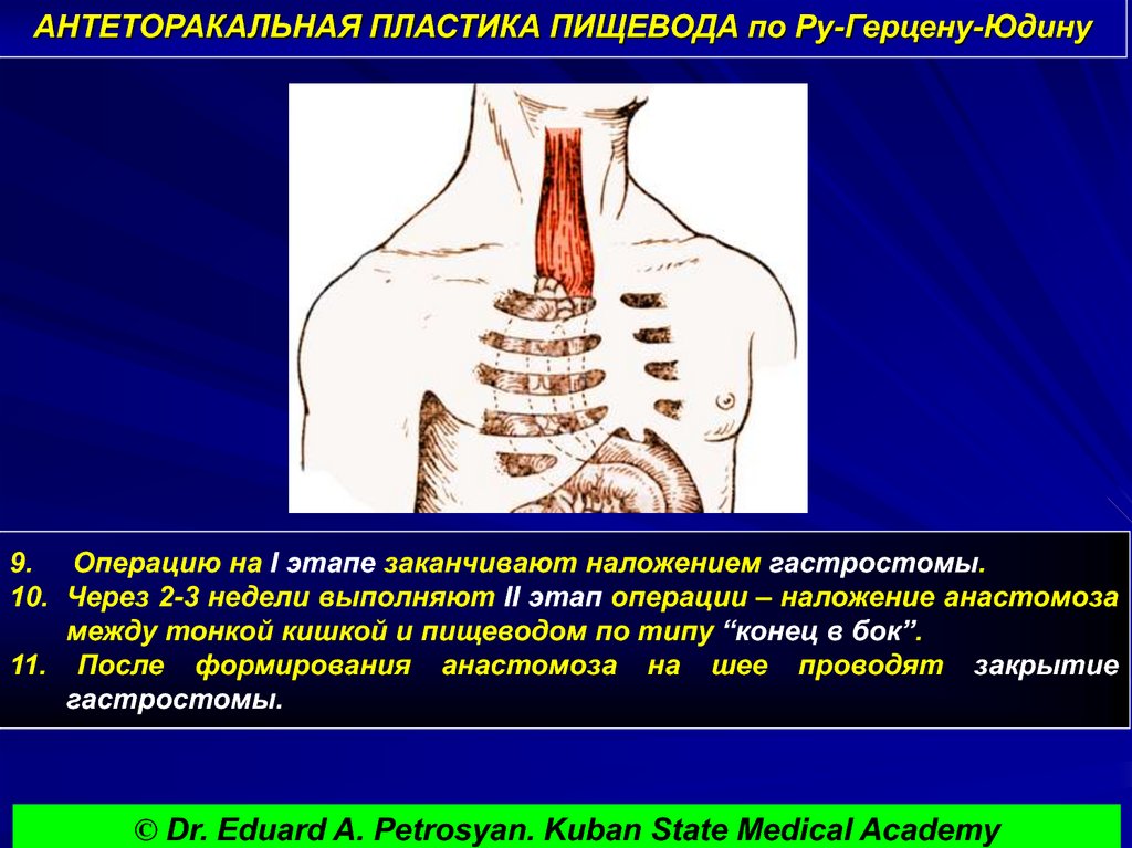АНТЕТОРАКАЛЬНАЯ ПЛАСТИКА ПИЩЕВОДА по Ру-Герцену-Юдину