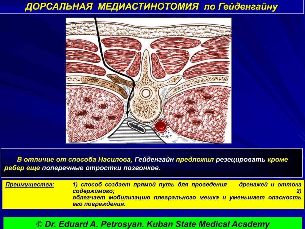 ДОРСАЛЬНАЯ МЕДИАСТИНОТОМИЯ по Гейденгайну