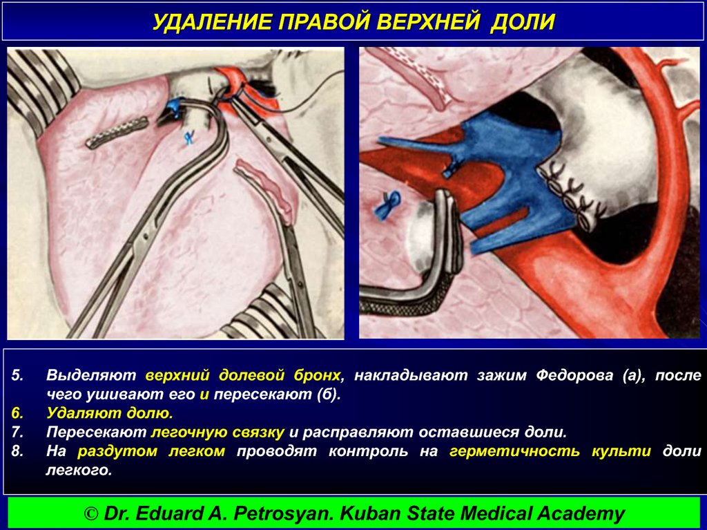 УДАЛЕНИЕ ПРАВОЙ ВЕРХНЕЙ ДОЛИ