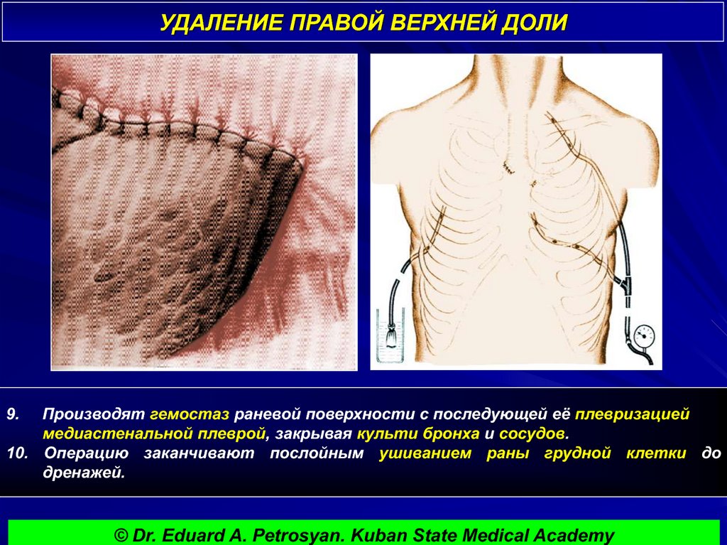 УДАЛЕНИЕ ПРАВОЙ ВЕРХНЕЙ ДОЛИ