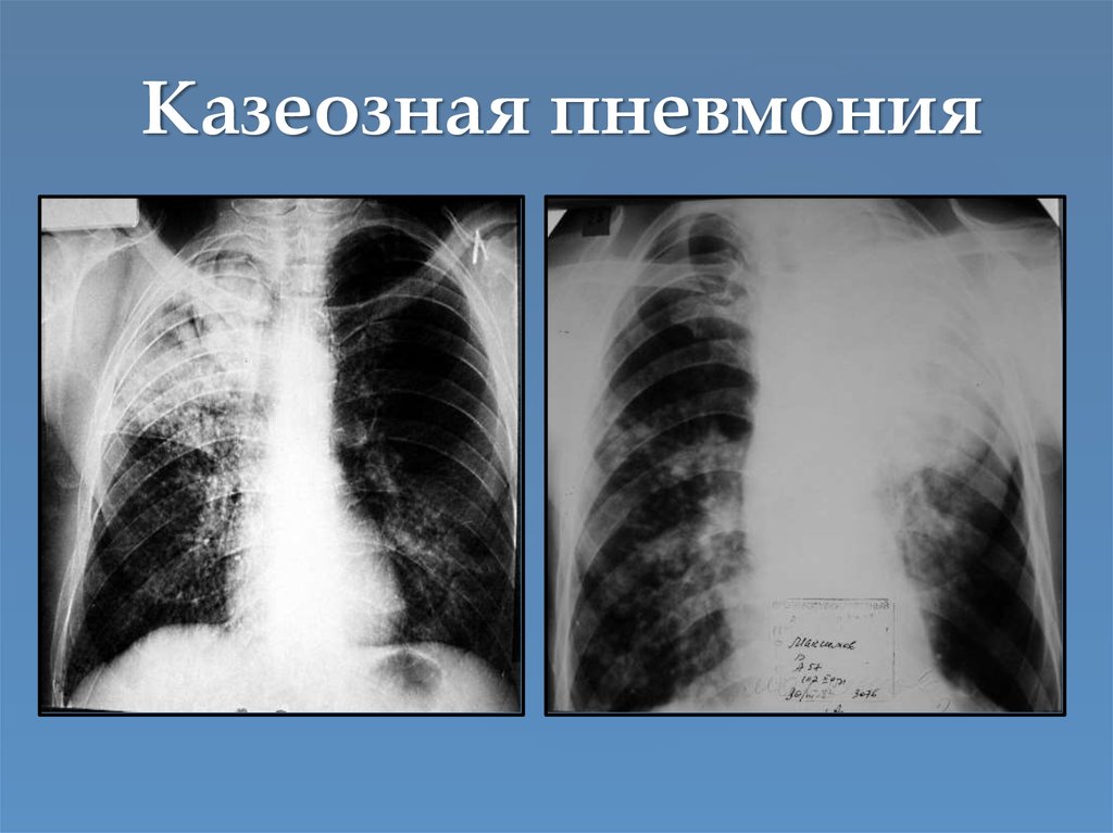 Затемнение на снимке. Казеозная пневмония легкого рентген. Казеозная пневмония рентген. Казеозная пневмония на рентгенограмме. Казеозная пневмония рентген снимки.