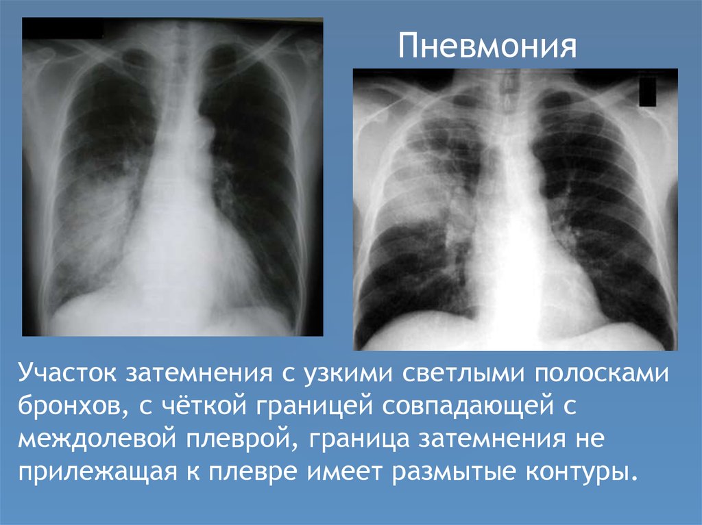 Усиление легочного рисунка на флюорографии