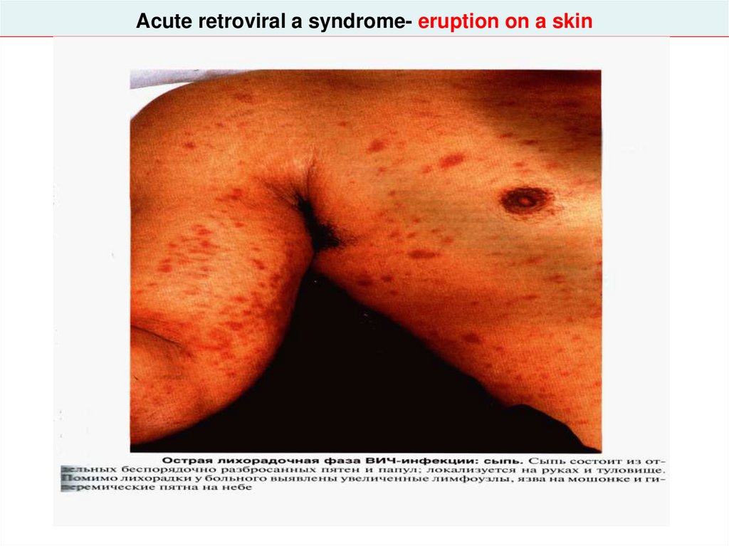 Acute retroviral a syndrome- eruption on a skin