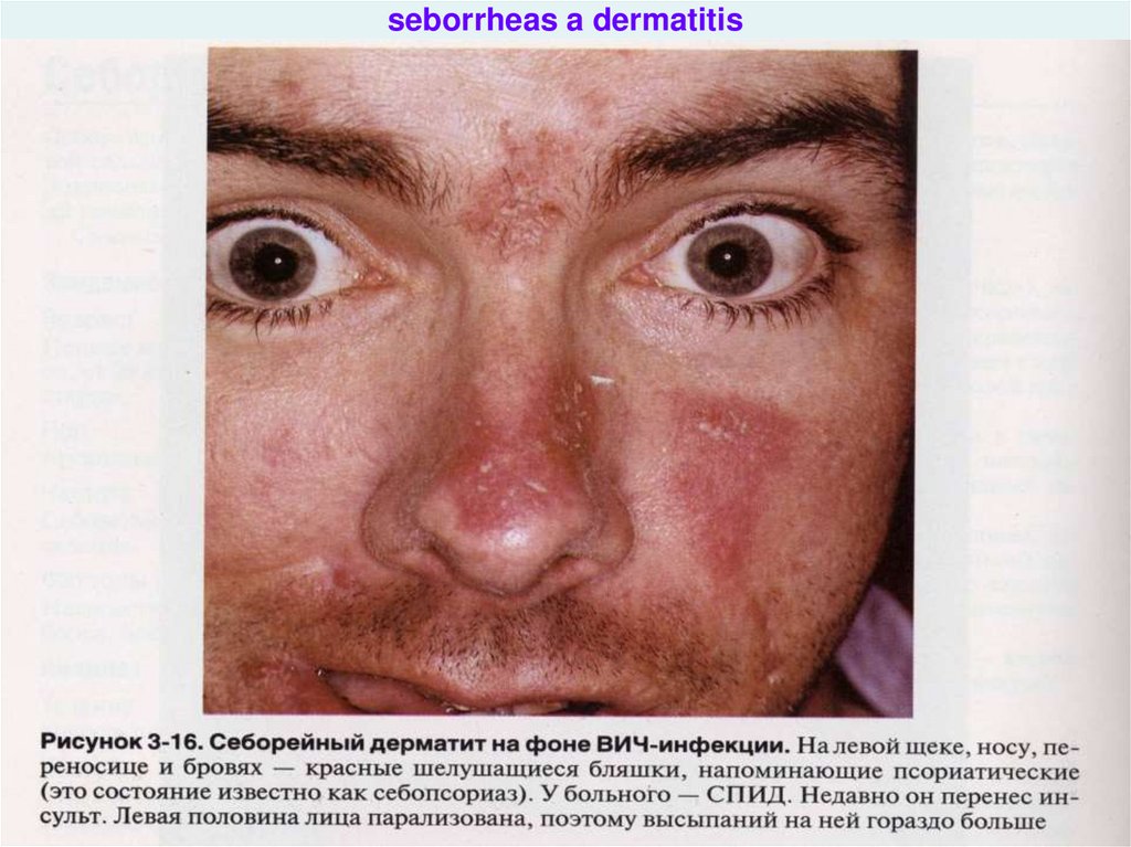 seborrheas a dermatitis
