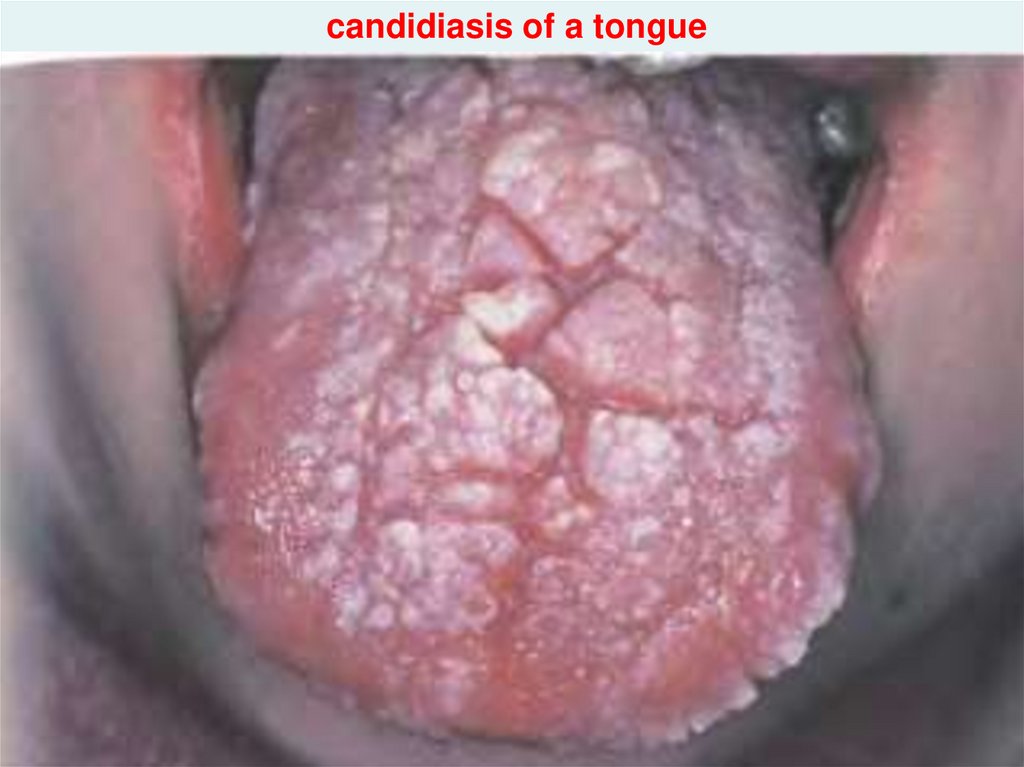 candidiasis of a tongue